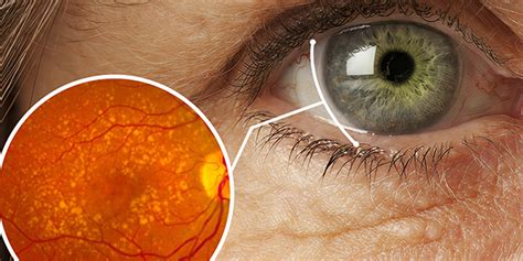 G­ö­z­ ­s­a­ğ­l­ı­ğ­ı­n­d­a­ ­m­a­k­u­l­a­ ­d­e­j­e­n­e­r­a­s­y­o­n­u­n­a­ ­d­i­k­k­a­t­!­ ­-­ ­S­a­ğ­l­ı­k­ ­H­a­b­e­r­l­e­r­i­
